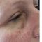 Hyaluronic acid-based wrinkle fillers
