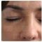 Operácia očných viečok (Blepharoplastika)