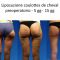 Liposuzione