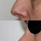 Operácia nosa (Rhinoplastika)