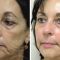 Liquid facelift