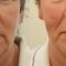 Facelift - 3D kanylové nitě