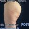 Lifting Glutei con Filo Elastico (Gluteoplastica)