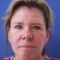 Eyelid surgery (Blepharoplasty)