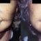 Fotorejuvenace / Resurfacing