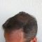 Trapianto capelli