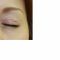 Eyelid surgery (Blepharoplasty)