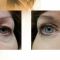 Eyelid surgery (Blepharoplasty)