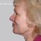 Facelift