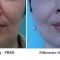 Facelift Silhouette Soft