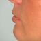 Hyaluronic acid-based wrinkle fillers