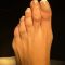 Bunion surgery (hallux valgus)