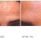 Botulinum toxin - Wrinkle Removal