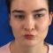 Lip augmentation - cheiloplasty