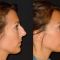 Rhinoplastie
