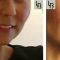 Augmentation des lèvres (acide hyaluronique)