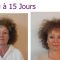 Mini lifting (lifting cervico-facial)
