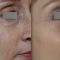Blépharoplastie inférieure