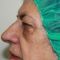 Operácia očných viečok (Blepharoplastika)