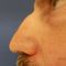 Plastika nosu (Rhinoplastika)