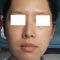 Korekcja uszu (Otoplastyka)