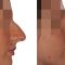 Rhinoplasty (Nose Job)
