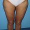 Liposuction