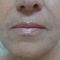 Liquid facelift