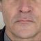 Teosyal, Restylane, Esthelis, Juverdem, Surgiderm (preparáty kyseliny hyaluronovej)