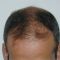 Trapianto capelli