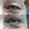 Eyelid surgery (Blepharoplasty)