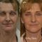Facelift, SMAS facelifting
