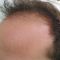 Trapianto capelli