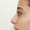 Rhinoplastie médicale