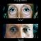 Blépharoplastie