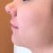 Lippenvergrößerung mit Hyaluronsäure