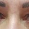 Operácia očných viečok (Blepharoplastika)