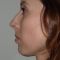 Rhinoplastie