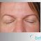 Operácia očných viečok (Blepharoplastika)
