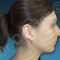 Rhinoplastie