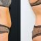 SlimLipo - laserová liposukcia