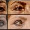 Operácia očných viečok (Blepharoplastika)
