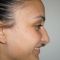 Rhinoplastie