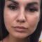 Botulinum toxin - Wrinkle Removal