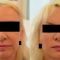 Facelift - 3D kanylové nitě