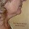 Lifting non chirurgico (Exilis)