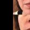 Filler antirughe a base di acido ialuronico