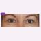 Operácia očných viečok (Blepharoplastika)