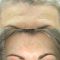 Operace čela (Forehead lift)