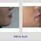 Hyaluronic acid-based wrinkle fillers